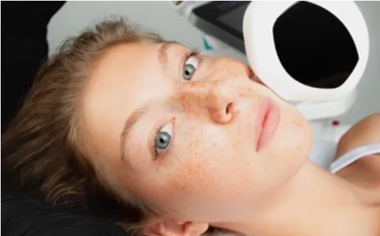 Dermapen Una solución estética eficaz y segura para revitalizar tu piel